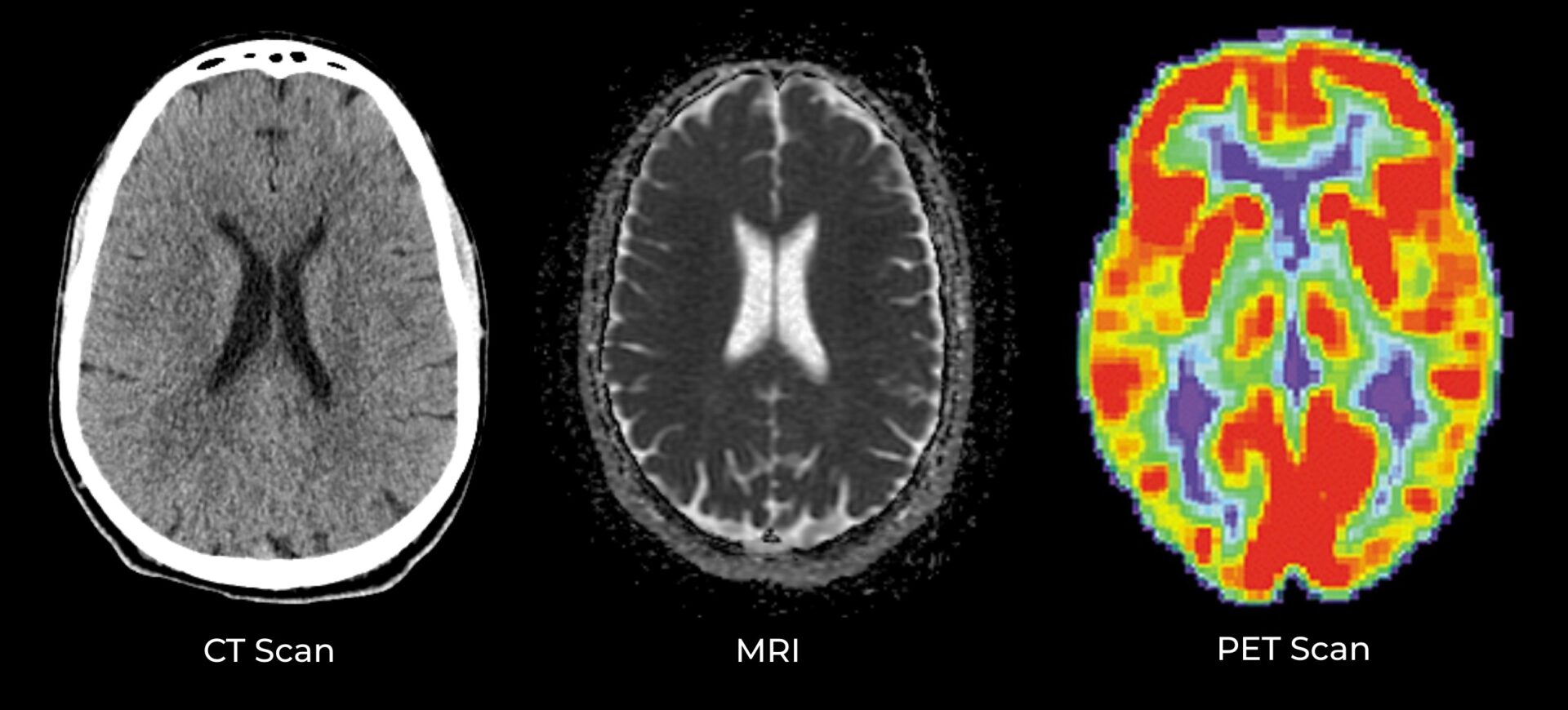 Examples of different brain imaging scans: CT Scan vs. MRI vs. PET Scan